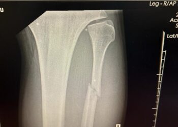 Pic: UFC 321 ‘Monster’ who made submission history did it with a broken leg